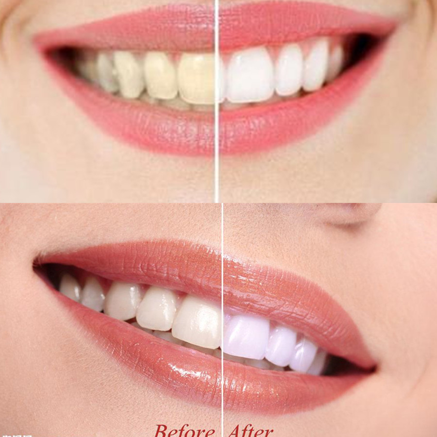 الخيزران الفحم الأسنان الأسنان - مراجعة Teeth Whitening Quotes وسعره