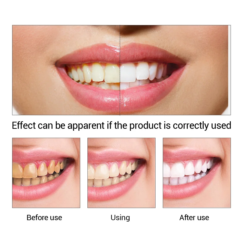 Fteenly تبييض الأسنان جوهر مسح - مراجعة Teeth Whitening Quotes وسعره